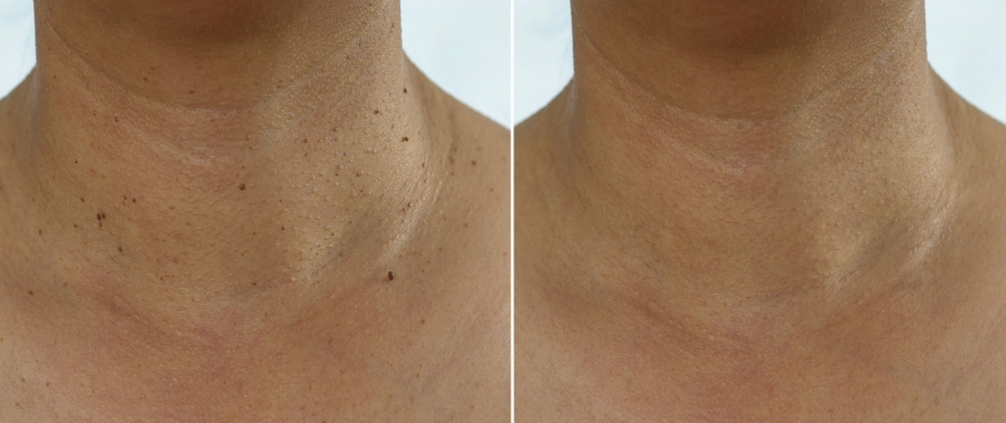 Skin Tag Removal Before and After