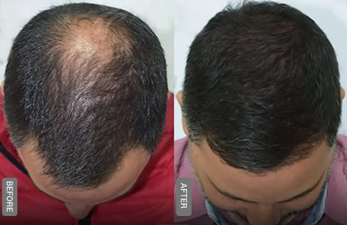 Hair Loss PRP Before and After